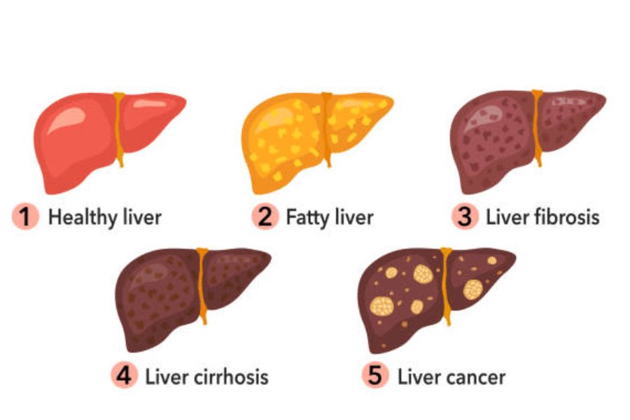 liverinhaler health – My Blog